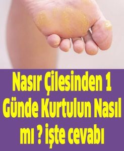 Özellikle Ayaklarda Meydana