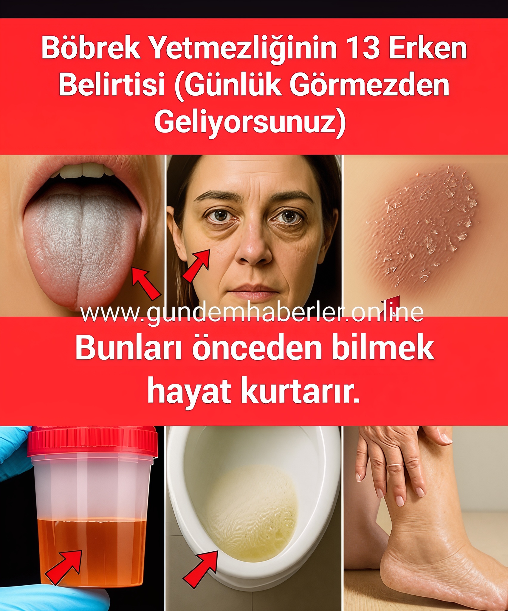 Böbrek Yetmezliğinin 13 Erken Belirtisi! Sessiz İlerliyor