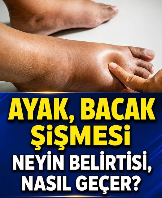 Ayak Bacak Şişmesi Neyin Belirtisi. - Fotoğraf 2