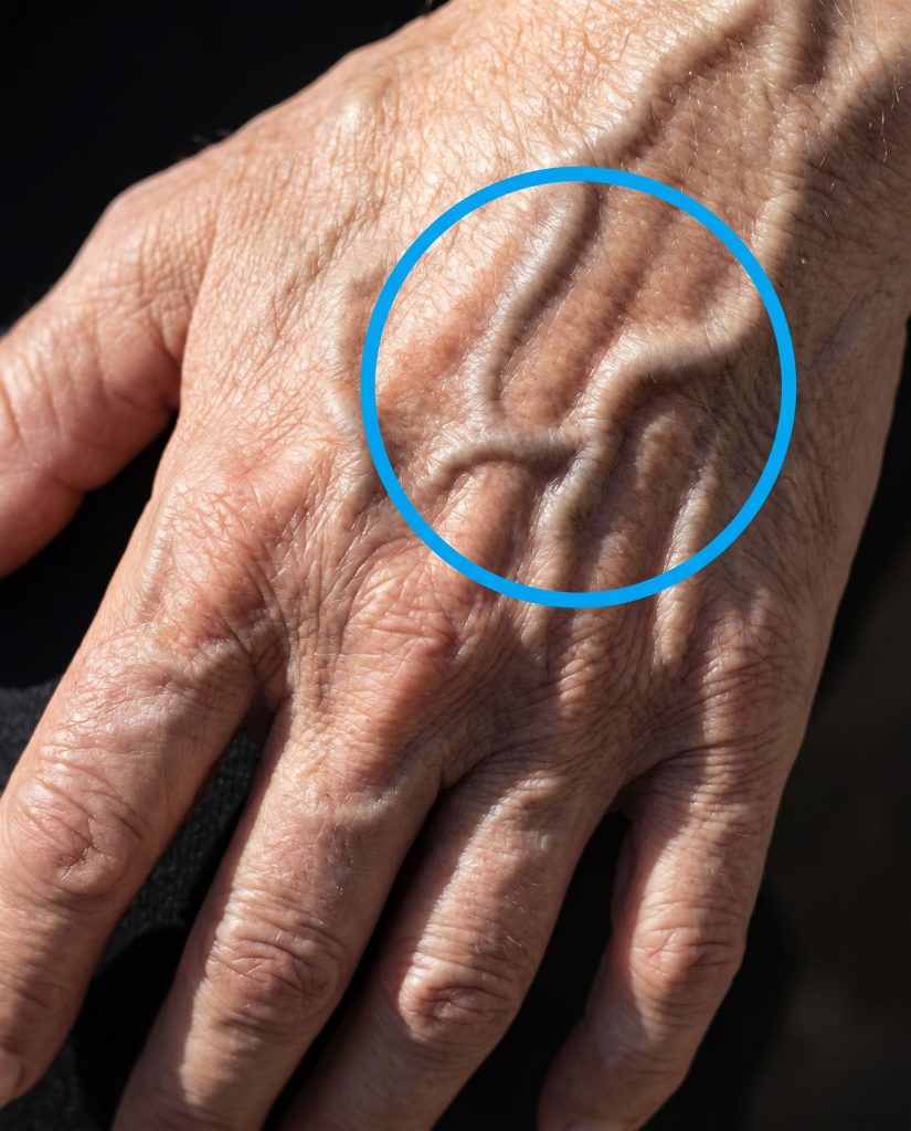 Görünür Damarlar Ne Anlama Gelir - Fotoğraf 2